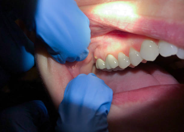 Best Dental Abscess Treatment in Iowa Colony, TX